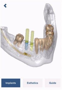 Impianti e viti di fissaggio sono visualizzati con il relativo spazio protesico nell'osso visibile in trasparenza. Sono visibili anche il nervo e i denti adiacenti (se presenti nel caso in esame).