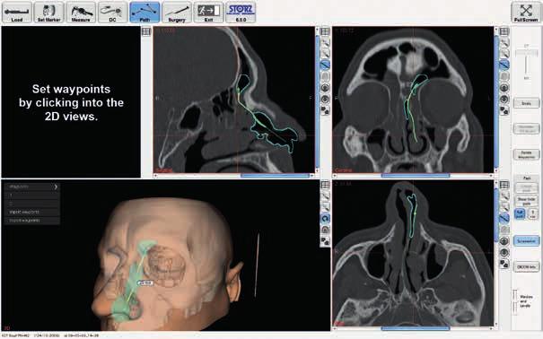 NAV1 SinusTracker L innovativo software di pianificazione per nuove vie di accesso nella chirurgia FESS Il software NAV1 SINUSTRACKER amplia il sistema KARL STORZ NAV1 ELECTROMAGNETIC permettendo la
