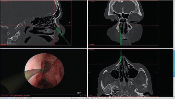 Navigatore per endoscopio NAV1 Endoscopia aumentata FESS con un nuovo adattatore di navigazione elettromagnetica per endoscopio L immagine endoscopica reale può essere ampliata con informazioni della