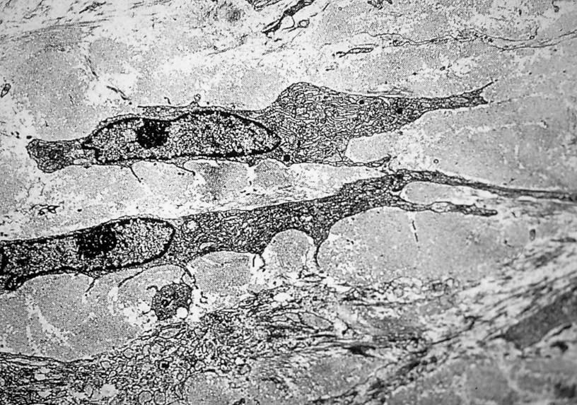 Due fibroblasti circondati da fibre collagene sezionate per lo più