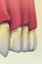 Sanguinamento, alitosi, mobilità dei denti sono altri segni di uno