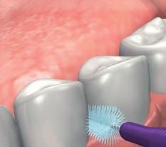 2 Per gli spazi più grandi esistenti tra i denti interessati dal ponte, scegliere uno scovolino di dimensioni