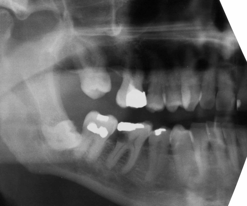 - anni 60 Elementi dentari interessati 46 Necrosi gangrenosa pulpare - protesica Amoxicillina 1+1g x dì x 4 gg Esito (valutazione dopo mesi 34) 15/5/01 Visita odontoiatrica; vasta cavità cariosa a