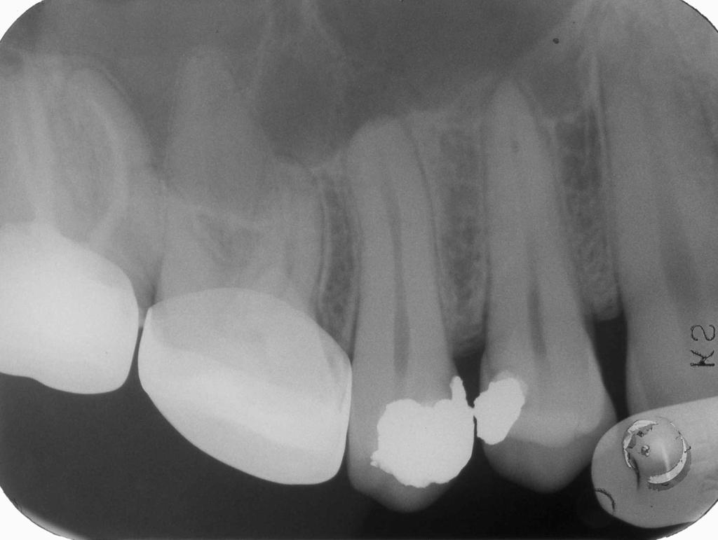 Caso clinico 26 Paziente: F.G. - anni 44 Elementi dentari interessati 15 Necrosi pulpare gangrenosa Amoxicillina: 1+1g x dì x 4 gg Esito (valutazione dopo mesi 36) 10/9/01 Ascesso odontogeno da 15; A.