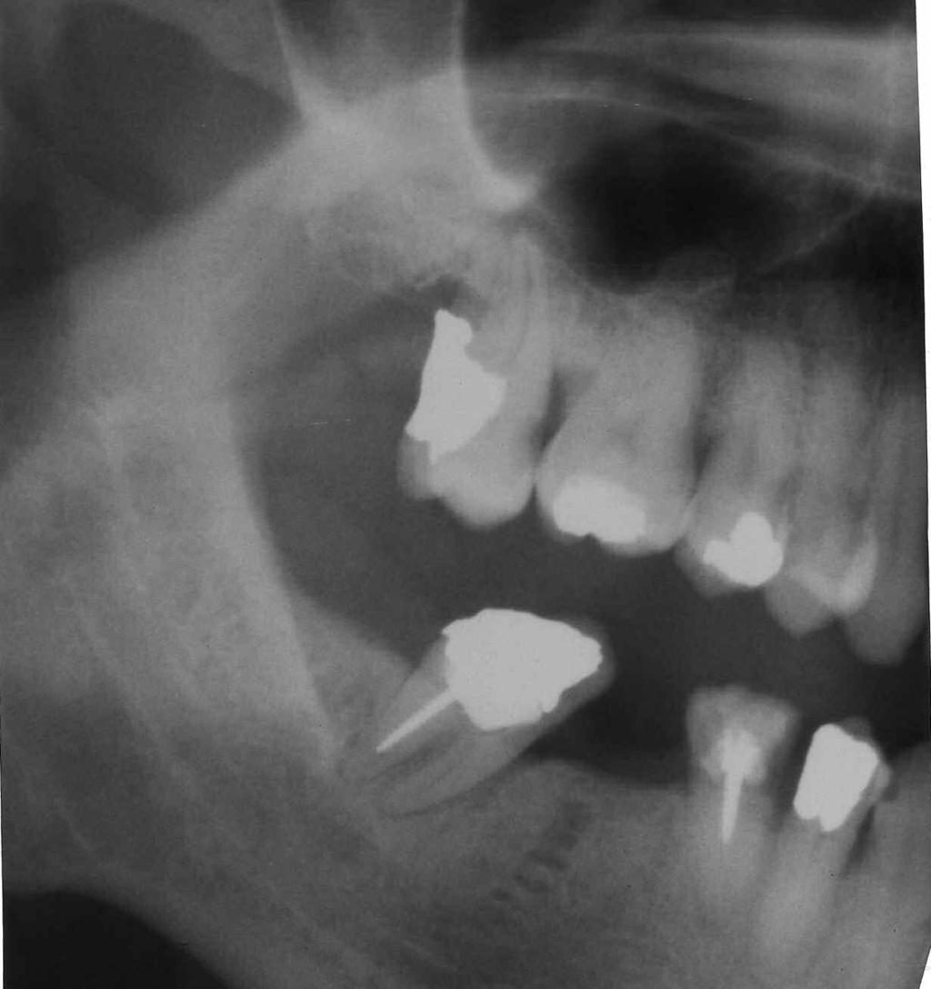 Esito (valutazione dopo mesi 40) 6/8/96 Visita odontoiatrica per ascesso odontogeno da 47; esame xgrafico.