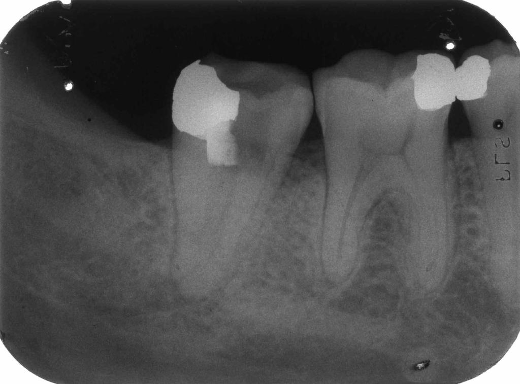 Caso clinico 47 Paziente: G.C. - anni 38 Sesso: F Elementi dentari interessati 47 Necrosi pulpare gangrenosa Prodotto utilizzato Endocalex Plus Amoxicillina x os: 1+1 cpr.