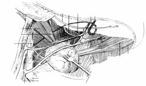 Exeresi delle ghiandole sottomandibolari e sottolinguali per via transcutanea 5 4 Fig.. Il triangolo sottomandibolare e le principali strutture anatomiche in esso contenute:.