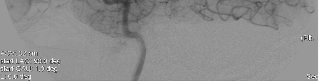 angiografici in corso di