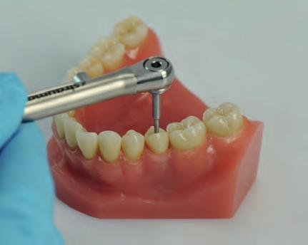 3.4 INSERIMENTO (PRESSO LO STUDIO DENTISTICO) Il restauro finale viene fissato sul modello master prima che venga consegnato allo studio dentistico.