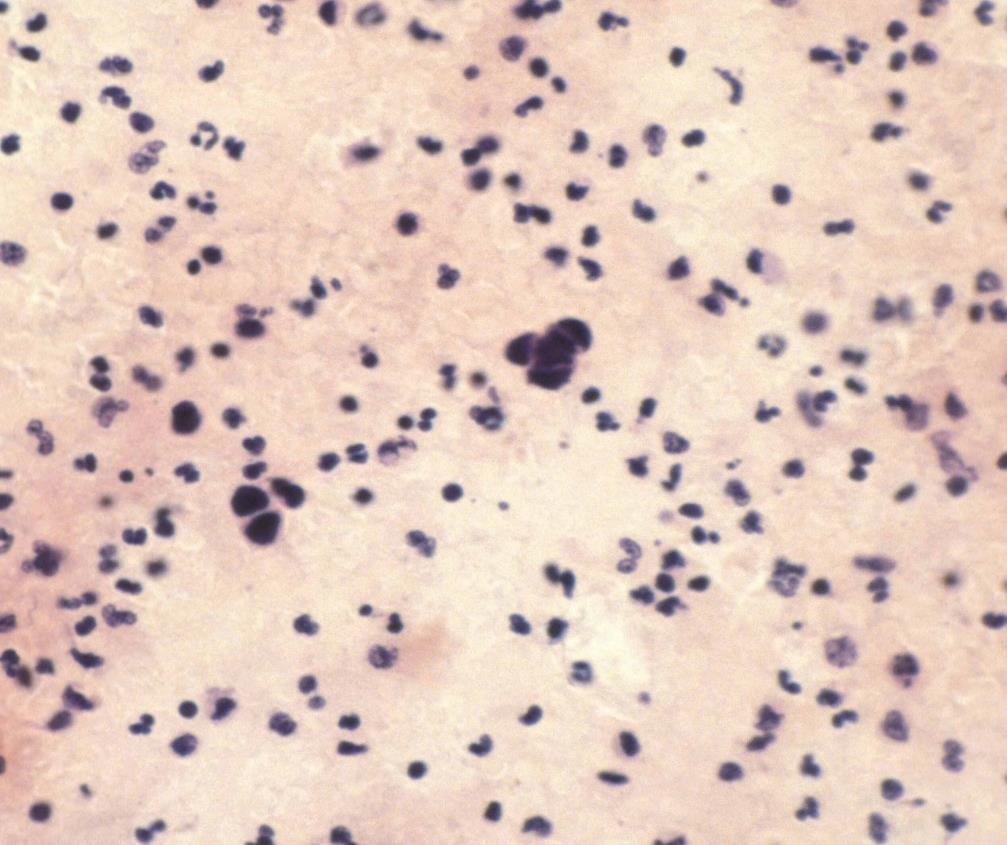 Carcinoma