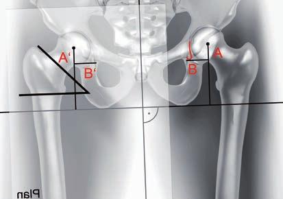 Tracciare una linea perpendicolare attraverso il centro della sinfisi e il centro del sacro Allineare una tangente orizzontale con la punta delle due tuberosità ischiatiche Determinare