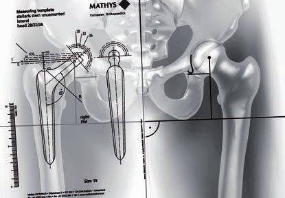 4 Usare i lucidi della protesi sul femore da operare per determinare la misura dello stelo (Fig. 5). Fig.