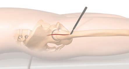 3. Tecnica chirurgica Per eseguire l impianto primario di una protesi totale d anca la tecnica descritta si