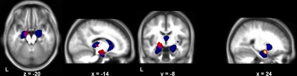 Un marker neurale dell avversione alle perdite Morfometria: correlazioni con il volume di materia grigia Maggior volume dell amigdala,