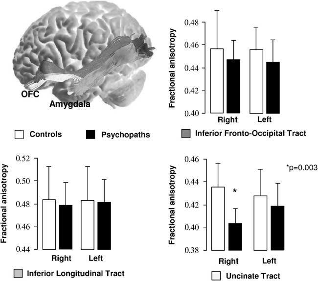 Psicopatia, rimorso e senso morale Psychopathy: lack of guilt, diminished capacity for remorse and poor behavioural control (Hare, 1991) Anomalie