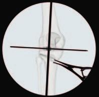 4 Verifica della linea articolare del ginocchio Verificare che la linea dell asse proiettata