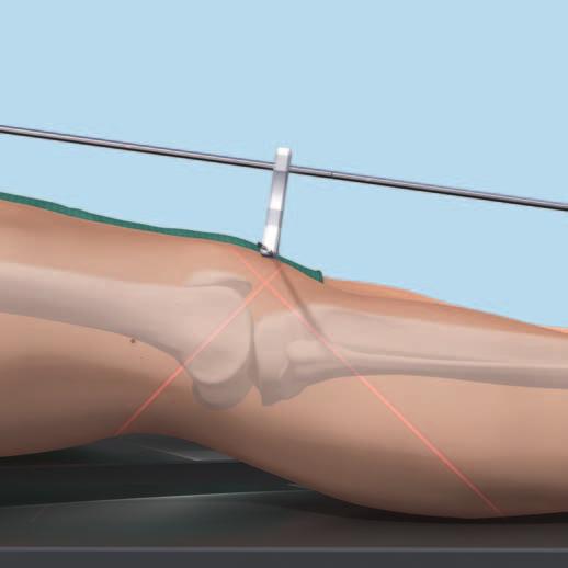 Tecnica opzionale Prima di effettuare un osteotomia il ginocchio deve essere esteso completamente;