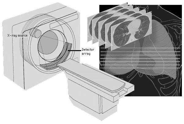 INTRODUZIONE La ricostruzione di immagini da strumentazione TAC Un sistema per tomografia assiale computerizzata (TAC) per poter produrre immagini dell interno del corpo umano, procede attraverso l