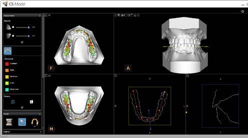 Applicazioni 3D Acquisizione facile di immagini del terzo molare utilizzando il bite block dedicato per gli