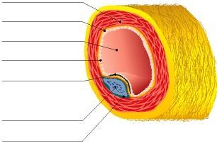 SVILUPPO DELL ATEROSCLEROSI PLACCA ATEROMASICA L aterosclerosi è un processo patologico nel quale il colesterolo, i detriti cellulari ed altre sostanze si accumulano all interno della parete