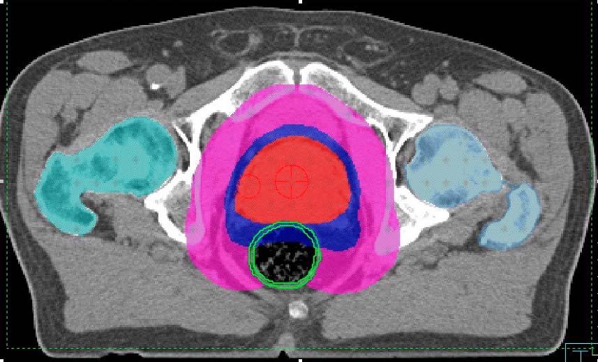 Volumes used PTV 68: the target volume that has to be irradiated to 68 Gy Annulus = PTV68 - PTV78 PTV 78: the target volume that has to be irradiated