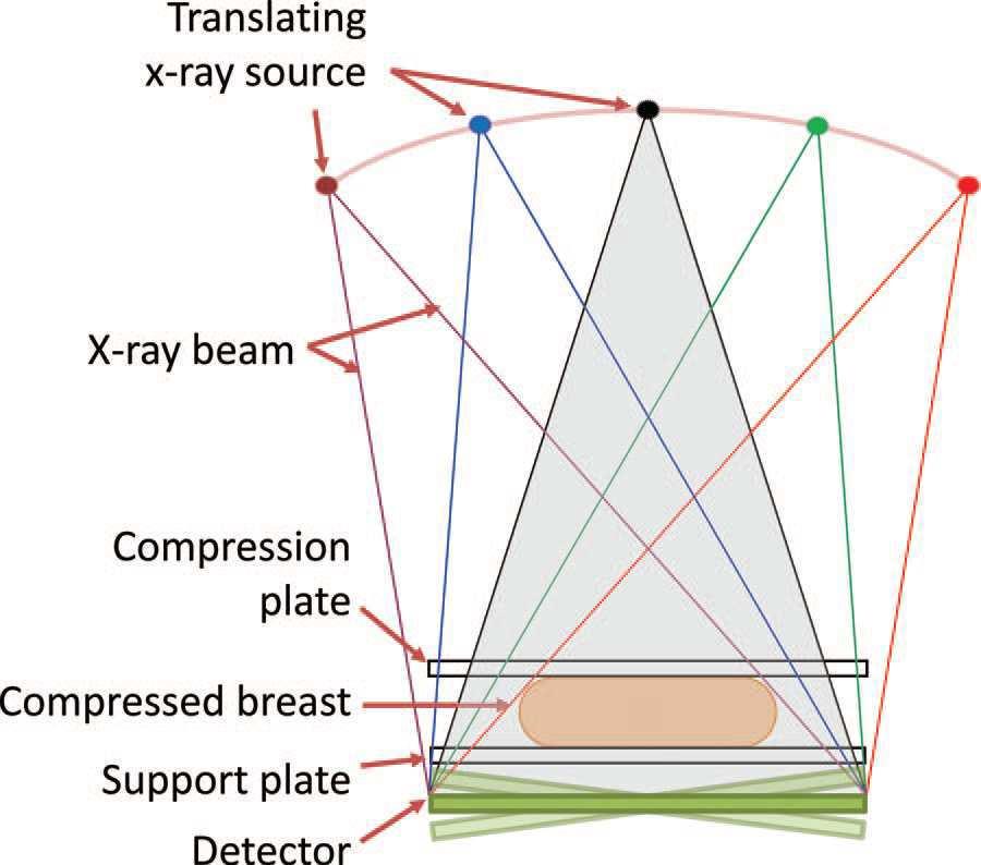 TOMOSINTESI Tecnica di imaging tridimensionale con geometria di acquisizione simile alla mammografia convenzionale, con la differenza che permette di ricostruire immagini volumetriche della mammella