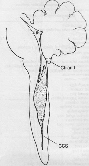 MIELORADICOLOPATIE SIRINGOMIELIA SIRINGOMIELIA NON COMUNICANTE DA MALFORMAZIONE DI CHIARI