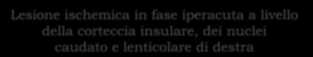 Lesione ischemica in fase iperacuta a livello della