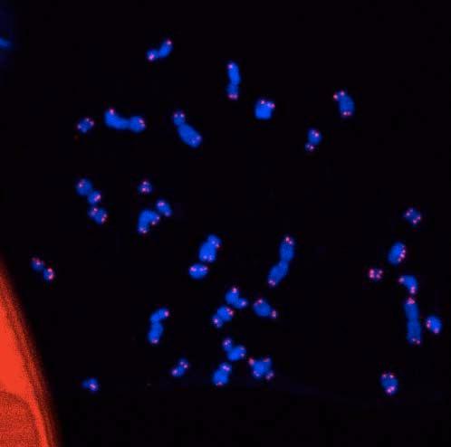 Diventare immortali: le cellule tumorali perdono i segni del tempo I telomeri alle estremità dei cromosomi (in rosso) Le cellule normali hanno una vita limitata.