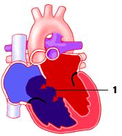 Cod.:LG TIPED Data: 15/01/2007 Rev.:00 Pagina 2 di 6 DEFINIZIONE Chiamata anche difetto dei cuscinetti endocardici questa cardiopatia, frequente nei pazienti affetti da S.