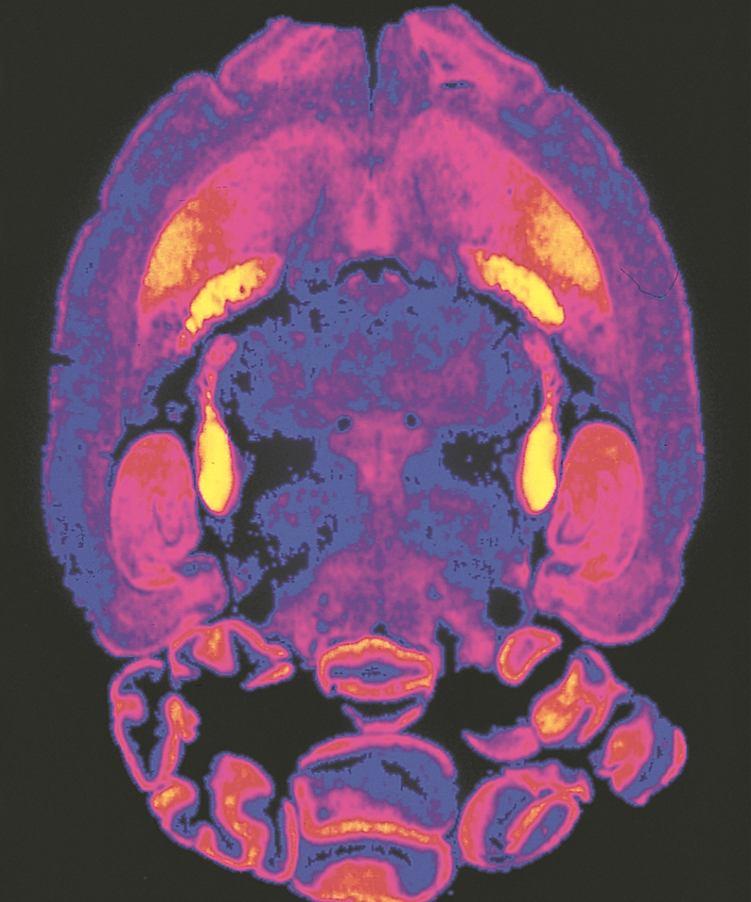 Allucinogeni: LSD o PCP Marijuana Stati alterati