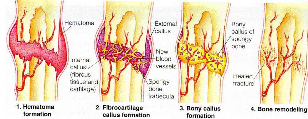 Riparo delle Fratture entrambi i tipi di ossificazione Formazione dell'ematoma