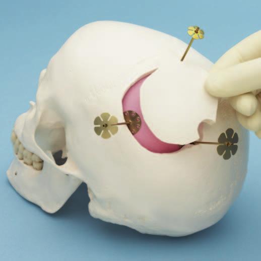 Tecnica chirurgica 3 Riposizionare il lembo osseo Riposizionare il lembo osseo nella posizione originale.