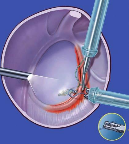 Il complesso capsulo-labrale viene perforato per mezzo di un ago di sutura e il filo portante viene fatto passare nella