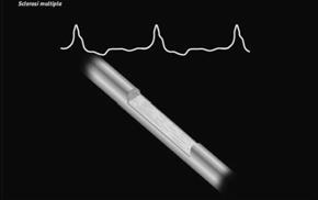 Se Na + non può entrare nell assone, una depolarizzazione che inizia nella zona trigger si riduce di intensità