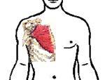 grande pettorale: cute e muscolo prelevati dalla regione mammaria e ruotati nell area del difetto c) Ricostruzione con autotrapianto di tessuto prelevato a distanza dall area asportata (lembi liberi