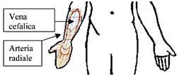 Lembo libero di avambraccio: viene prelevata una porzione di cute della superficie volare (la parte interna, senza peli) dell avambraccio con l arteria radiale e la vena cefalica.