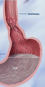 Barriera Acida Gastrica Acido cloridrico gastrico distrugge batteri e virus