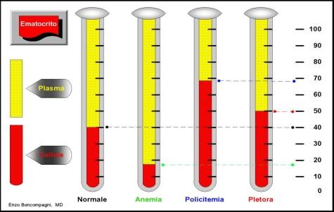 Ematocrito Approccio diagnostico alle anemie Definizione: una riduzione nella concentrazione di emoglobina al di sotto dei valori normali per età e sesso criteri WHO: Maschio < 13g/dL Femmina <