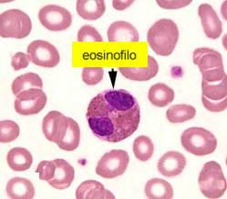 LDH: leucemia, anemia