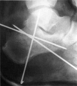 osseo (Norian) Fig. 4 A, B, C). Fig. 4A C.F. Paziente di 37 anni maschio con frattura talamica di tipo 3 Fig.