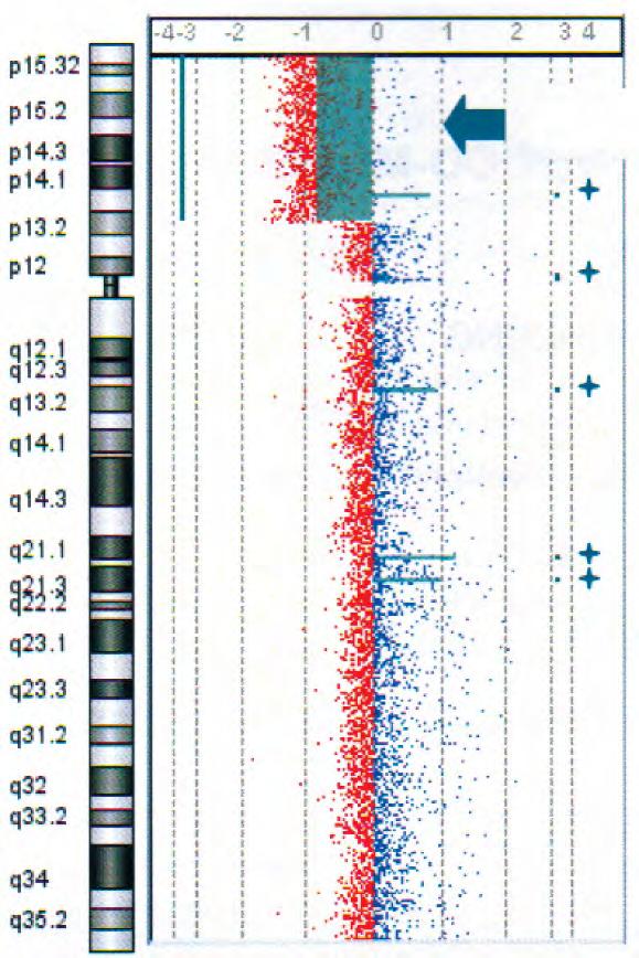 Chr. 5 Identifica una delezione 5p confermata con array-cgh Chr.