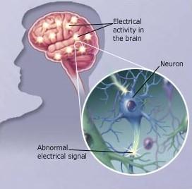 LGI-1 e epilessia Attività elettrica cerebrale Neurone Epilessia: malattia