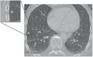 fig. 4 - Immagine assiale TC del torace eseguito che identifica nodulo solido mantellare di 4.5 mm in corrispondenza del lobo inferiore del polmone di destra. fig.