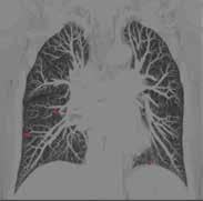 iperdense come le strutture vascolari polmonari ed i noduli polmonari. fig. 6 - Elaborazione tridimensionale del volume del nodulo polmonare solido con algoritmo specifico (Volume Rendering).