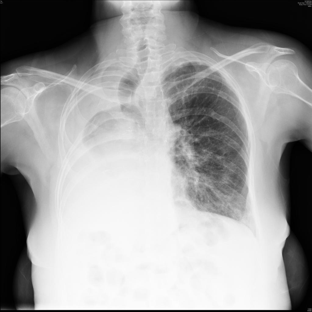 Trapianto polmonare singolo sinistro e pneumonectomia destra in paziente 34