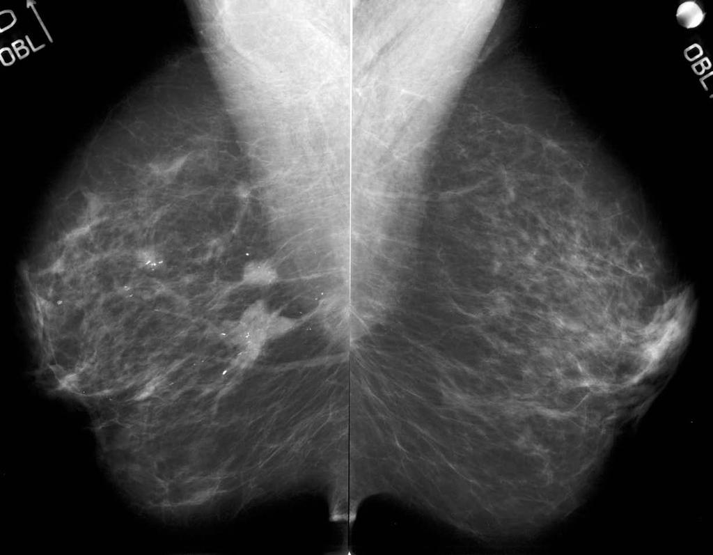 Storia della Mammografia: l immagine
