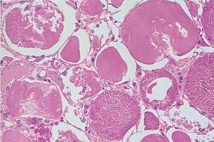 NECROSI TUBULARE ACUTA TOSSICI ENDOGENI MIOGLOBINA (sindrome da schiacciamento)