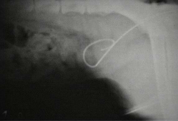 Complicazioni rottura iatrogena della vescica o dell uretra (catetere o sovradistensione) accumulo intraparietale di mdc
