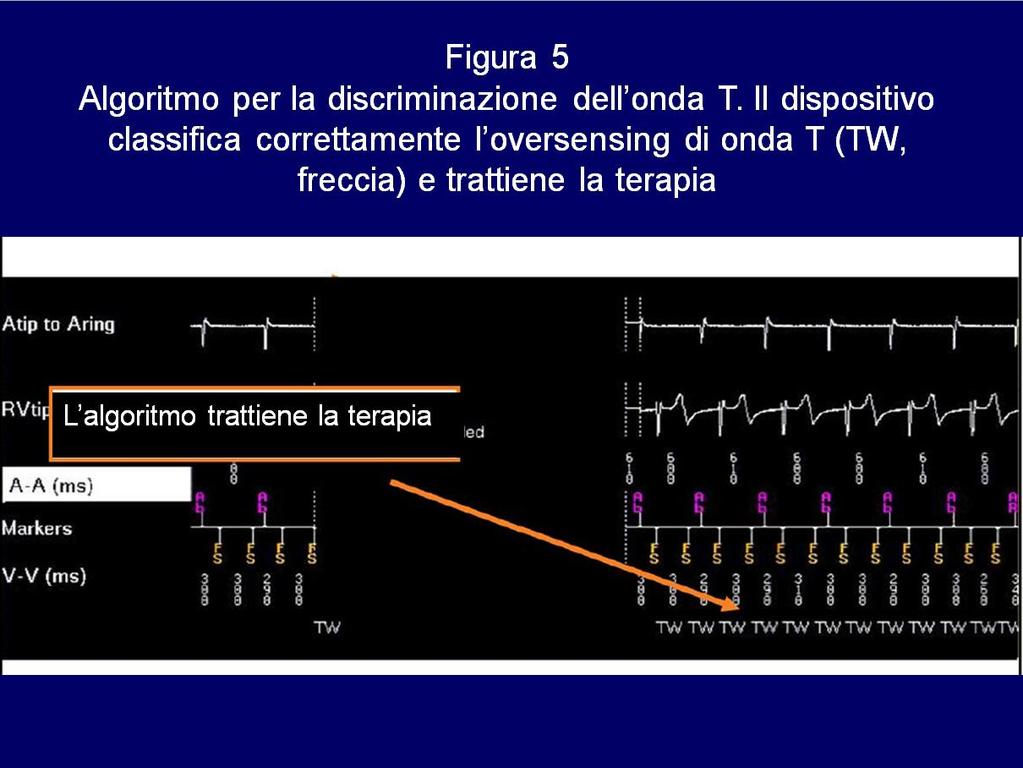 Nella Figura 3 l erogazione dello shock sull onda T induce FV che viene correttamente riconosciuta dal dispositivo e interrotta con un secondo shock.